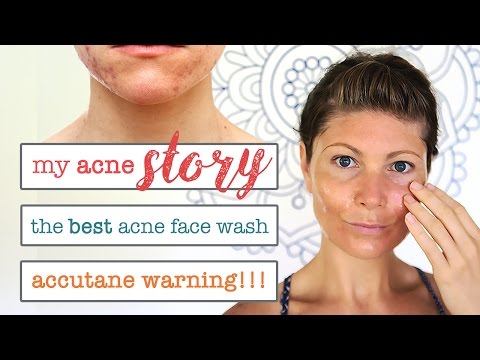 MY ACNE STORY // HOMEMADE ACNE FACE WASH // DON'T TAKE ACCUTANE UNTIL YOU WATCH THIS