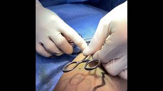 Phlebectomy: Varicose Veins Treatment