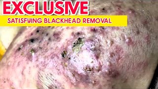 Relax Everyday With Poppy Tv Blackhead removal