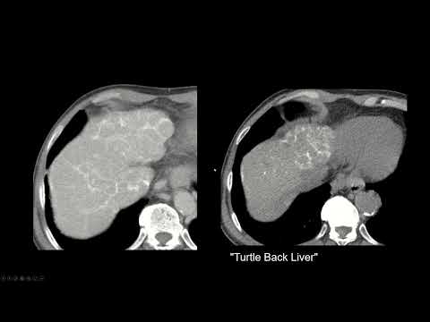 Interpreting CT Abdo: Cirrhosis, Portal Hypertension, Schistosomiasis