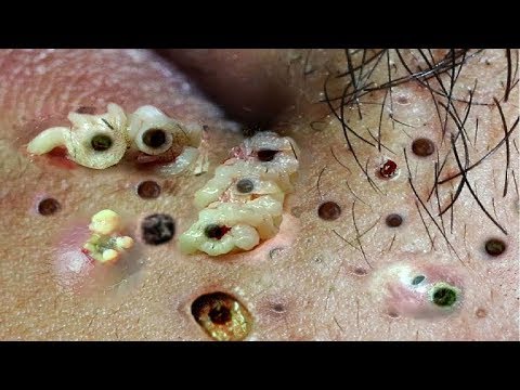 Popping huge blackheads and Pimple Popping - Best Pimple Popping Videos #3