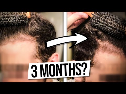 Hair Loss Treatments That KEEP WORKING, Even After Quitting?