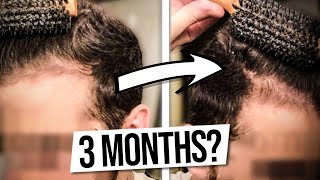 Hair Loss Treatments That KEEP WORKING, Even After Quitting?