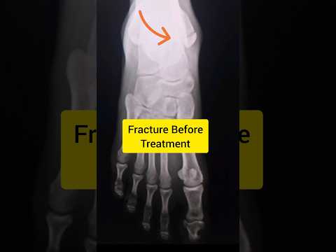 Malleolus Fracture