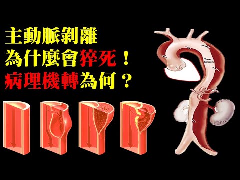 什麼是主動脈剝離？有什麼症狀？小鬼為何離世又急又快？｜許原彰醫師