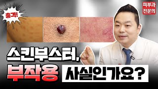 핫한 스킨부스터 부작용 예방법 & 치료법 [스킨부스터 ㅣ 스킨부스터부작용]