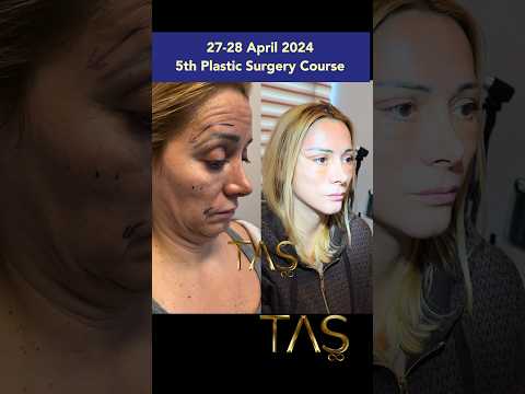 #scarlessdeepplanefacelift How I did it?5th Plastic Surgery Course, 27-28 April 2024