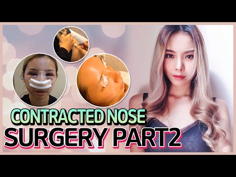 CONTRACTED NOSE REVISION RHINOPLASTY : KOREAN PLASTIC SURGERY VLOG PT.2