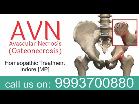 Avascular necrosis AVN osteonecrosis Homeopathic Treatment dr ak Dwivedi Anand Gujrat Vijay Patel