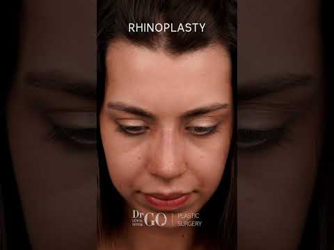 Rhinoplasty Transformation by Assoc. Prof. Dr. Güncel Öztürk | Before & After Results