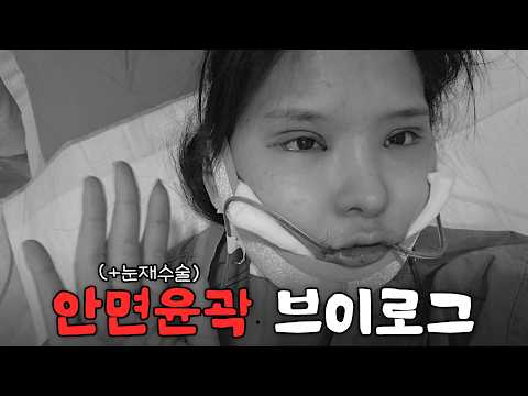 안면윤곽 브이로그+5개월차 솔직 후기🤧 | 눈재수술 | 윤곽처짐? 흉터? 부기? 사각턱?