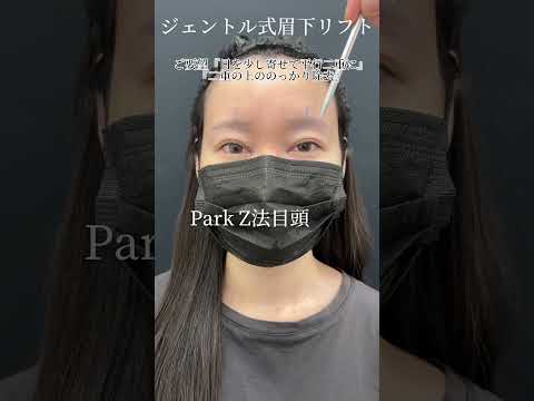 細かすぎる眉下デザイン。眼輪筋弁骨膜固定併用。 #眉下リフト #眉下切開 #眼瞼下垂