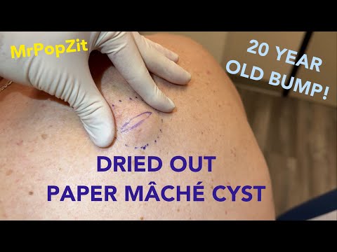 Very dried out large bump on back. Full sac removal and 2 week follow up at end of video,healed well