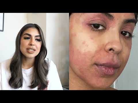 this ruined me… here’s how i’ve been healing | eczema story time