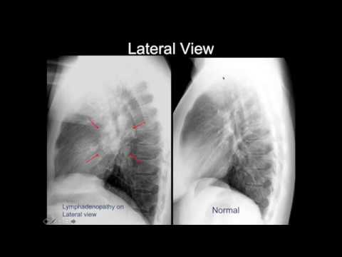 Chest X-ray: Cases 2