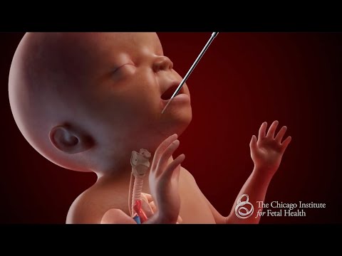 CDH Care from FETO to Long-Term Follow-Up – The Chicago Institute of Fetal Health