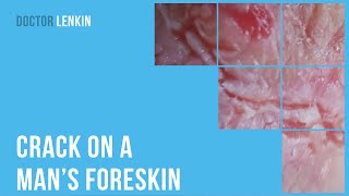 😨 Crack on a man’s foreskin