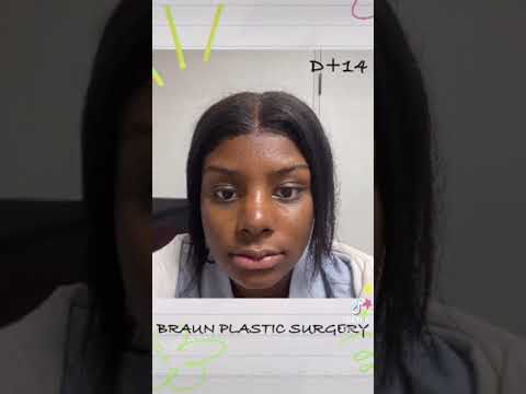 Surgery recovery - ethnic nose job, facial contouring surgery