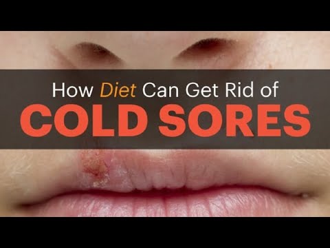 Why Cold Sores Keep Coming Back and How to Stop Them | 5 Home Remedies for Cold Sores