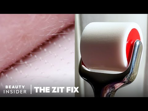 Microneedle Tool Has 3,000 Dissolving Needles, Which Improve Appearance Of Skin | The Zit Fix