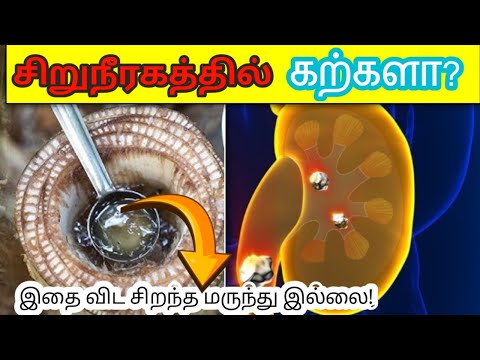 இவற்றை சாப்பிட்டாலே போதும் சிறுநீரக கல் இனி வராது | Best Home Remedies for Kidney stones in tamil