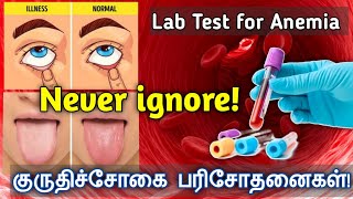 இரத்தசோகை பரிசோதனை/இரத்தசோகையின் அறிகுறிகள்/Lab Test for Anemia in Tamil/குருதிச்சோகை என்றால் என்ன