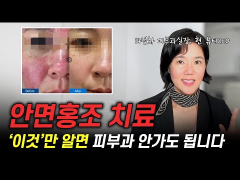 안면홍조 피부과 대신 집에서 해결하는방법