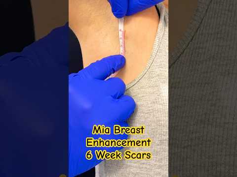 6 Week @miafemtech scar recovery #miaprocedure #breastenhancement #miafemtech