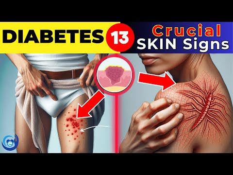 13 crucial skin signs of diabetes