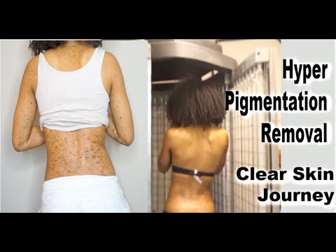 UPDATE What Happened To My SKIN | UVB Phototherapy for hyper pigmentation & dark spots| Skin Journey