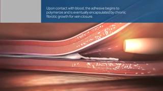 VenaSeal Closure System animation