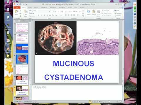 Medical School Pathology 2012 Session 059 Pancreas and Lab.mp4