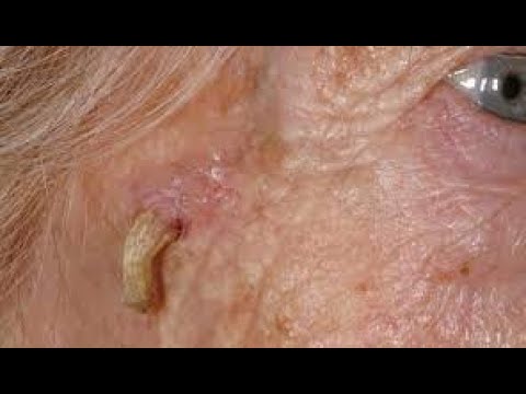 Big deep | new blackheads this week