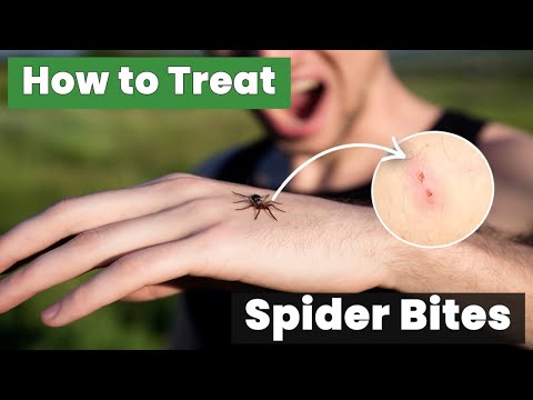 How to Treat Spider Bites at Home? Try These Natural Solutions