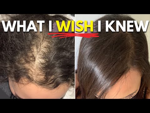 What I WISH I Knew About Hair Loss and Hair Growth Before It Was Too Late!!