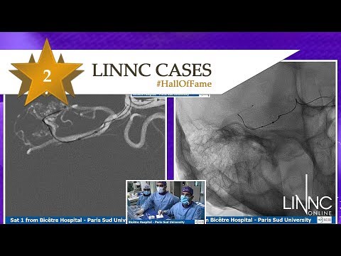 MCA saccular aneurysm treated with FRED Flow diverter stent