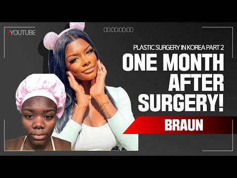 Jaylyn's (ethnic nose job)  Rhinoplasty and Facial Contouring Surgery recovery timeline - One month!