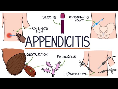 Understanding Appendicitis