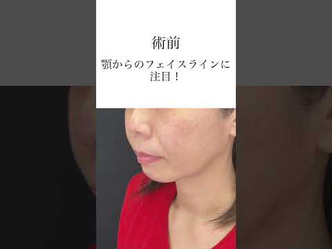 【小顔治療】若返りも小顔も同時に叶える！ #京様の小顔術 #京様の若返り術  【美の主治医京様】