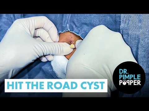 Hit the Road Cyst