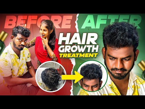 HAIR GROWTH TREATMENT 💂🏻‍♀️💂🏻‍♀️ Jabardasth nukaraju & asiya latest video // hair fall men’s