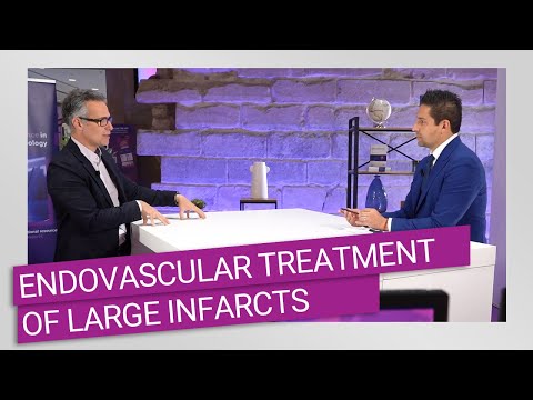 How to manage current challenges in the endovascular treatment of large infarcts?