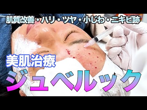 【施術動画】美肌治療！ジュベルックを公開