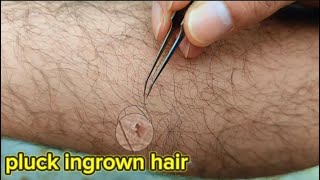 Part 112 Plucking ingrown legs hair, nhổ lông mọc ngược, نتف الشعر الناشئ