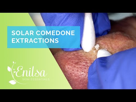 Solar Comedone Extractions