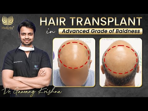 Hair Restoration in Advanced Grade of Baldness | Hair Transplant Doctor in Delhi | Medlinks