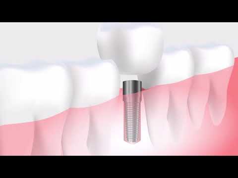 Tooth Implant Animation | Copyright Free Video Footage