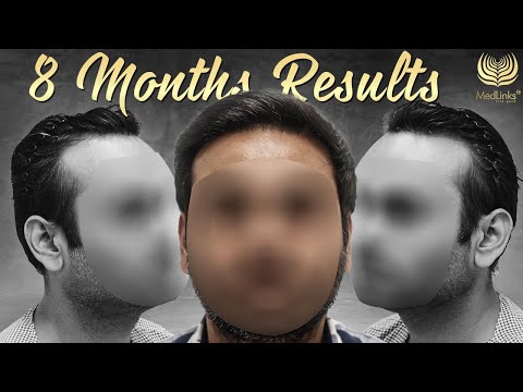 Amazing Hair Transplant Journey | 8-Month Hair Transplant Results | MedLinks