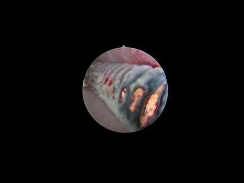 Hysteroscopic guided removal of IUCD Rooma Sinha Apollo hospitals