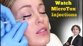 Watch MicroTox Eye Injections-Before and After